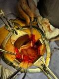 Abdominal 17